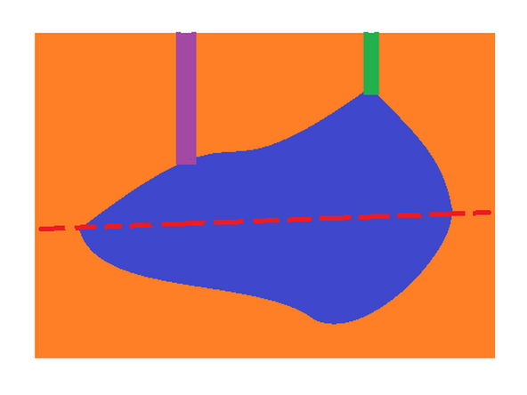 The sprue is the primary channel that acts as the entry point for the resin material into the mold. In this case it enters the mold cavity directly.