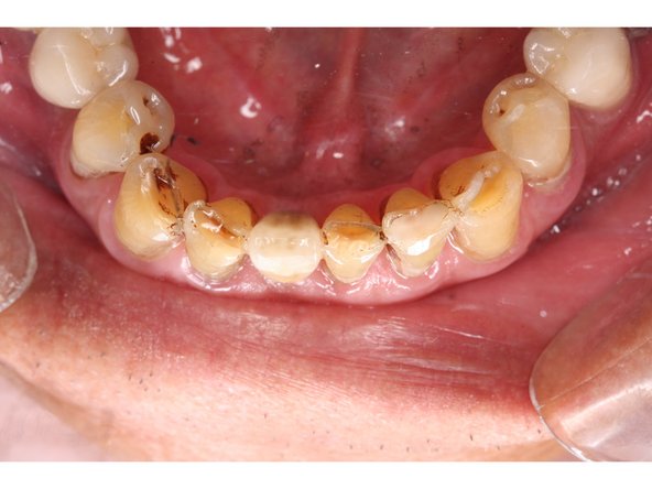 將假牙裝戴上之狀況,微型植體較符合東方人前牙細窄的齒槽骨及細小的牙根型態