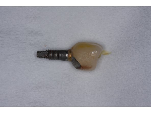 從掉落的植體可見上方堆積的牙結石與煙焦油