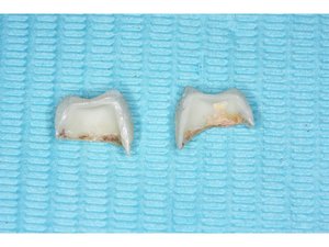 全瓷/鋯冠要用哪種Bur拆除