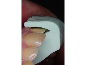 修牙厚度指引粘土