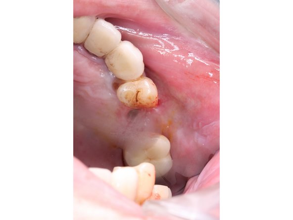 請患者用鼻子吹氣,有霧氣跑到拍攝鏡面上表示鼻竇膜有破損