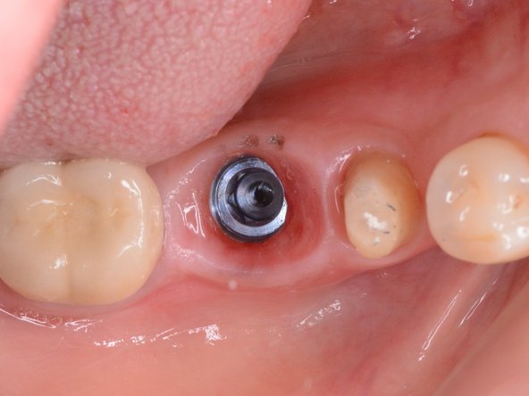 使用漱口水沖洗牙齦周圍沈積的食物殘渣及髒污