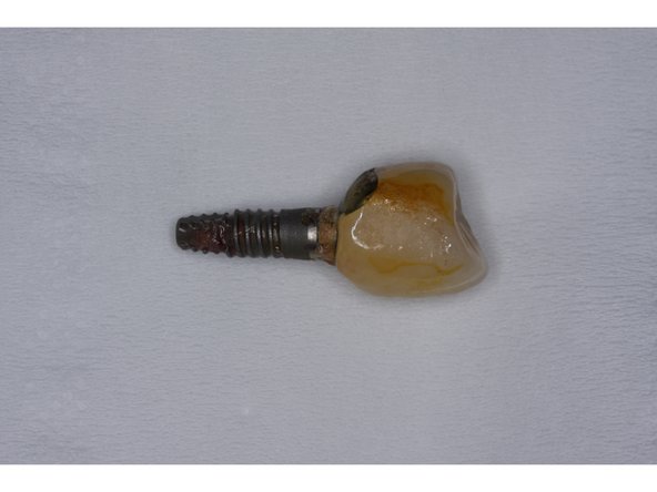 從掉落的植體可見上方堆積的牙結石與煙焦油