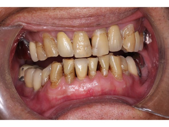 將假牙裝戴上之狀況,微型植體較符合東方人前牙細窄的齒槽骨及細小的牙根型態