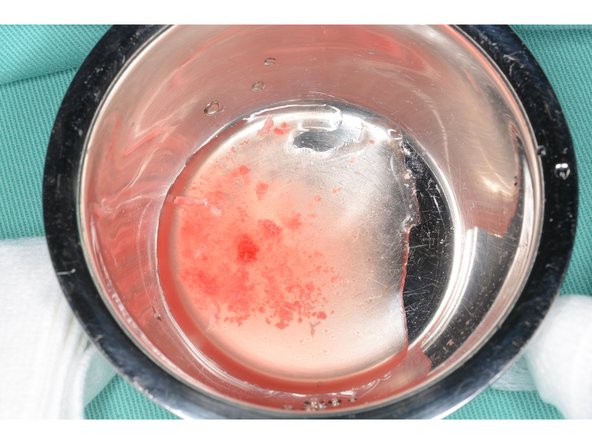 鑽骨時用轉速200轉,不噴水,可於鑽針凹槽上見到殘留的自體骨,用食鹽水沖下於骨粉托盤,吸乾食鹽水後可取出自體骨補骨