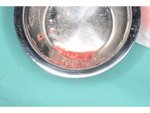 鑽骨時用轉速200轉,不噴水,可於鑽針凹槽上見到殘留的自體骨,用食鹽水沖下於骨粉托盤,吸乾食鹽水後可取出自體骨補骨