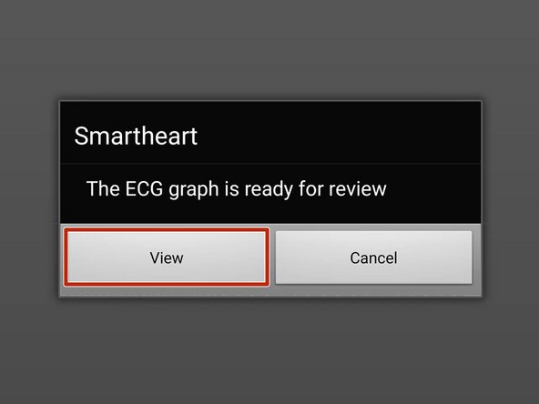 When the ECG is ready for review a SmartHeart® message will appear.